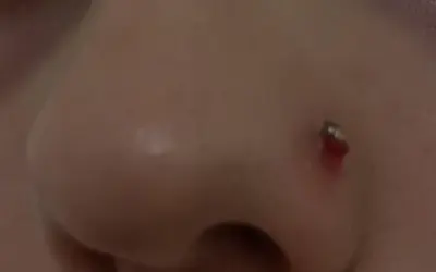 Widoczna ziarnina nostril, zaczerwieniona i lekko krwawiąca przy kolczyku. Jak się pozbyć tego problemu?