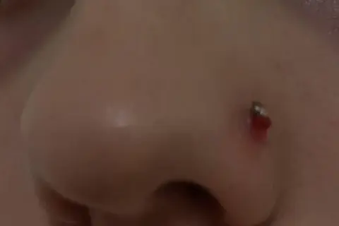 Widoczna ziarnina nostril, zaczerwieniona i lekko krwawiąca przy kolczyku. Jak się pozbyć tego problemu?