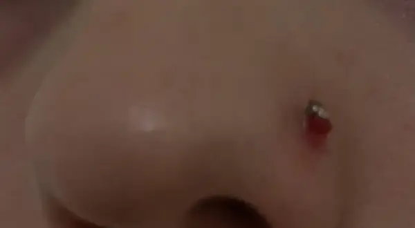 Widoczna ziarnina nostril, zaczerwieniona i lekko krwawiąca przy kolczyku. Jak się pozbyć tego problemu?