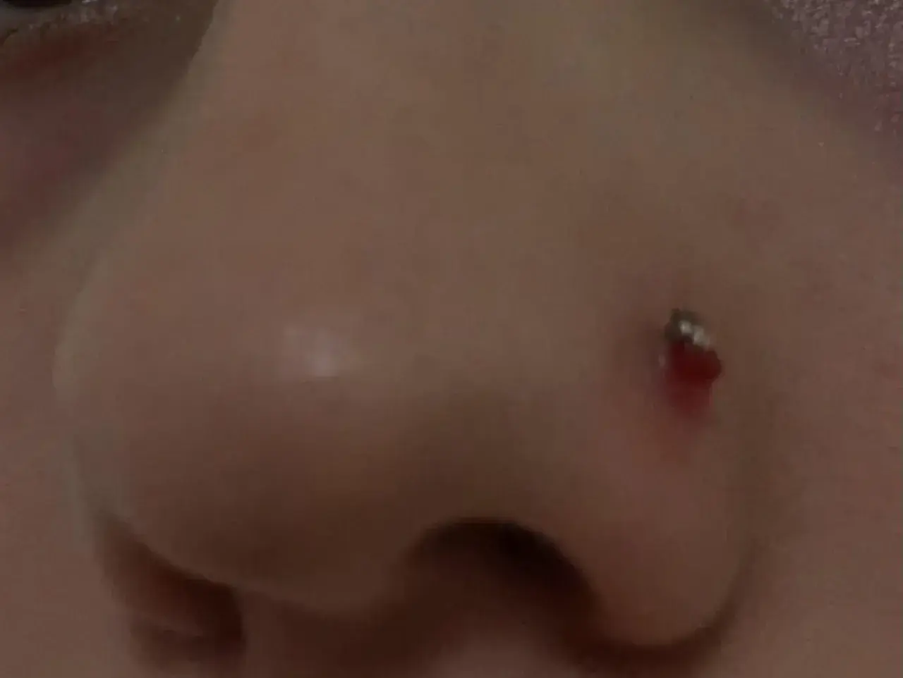 Widoczna ziarnina nostril, zaczerwieniona i lekko krwawiąca przy kolczyku. Jak się pozbyć tego problemu?